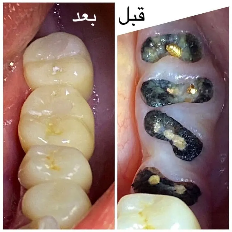 ترميم أسنان قبل وبعد